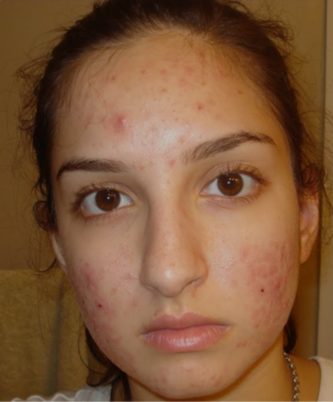 Close-up of a person with visible acne on their face.